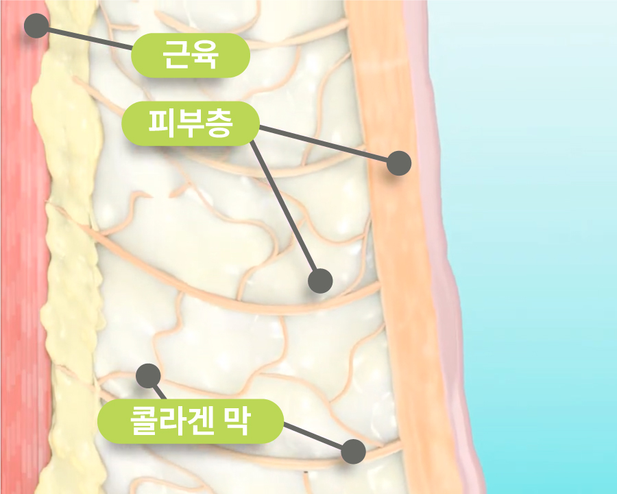 Thermage FLX