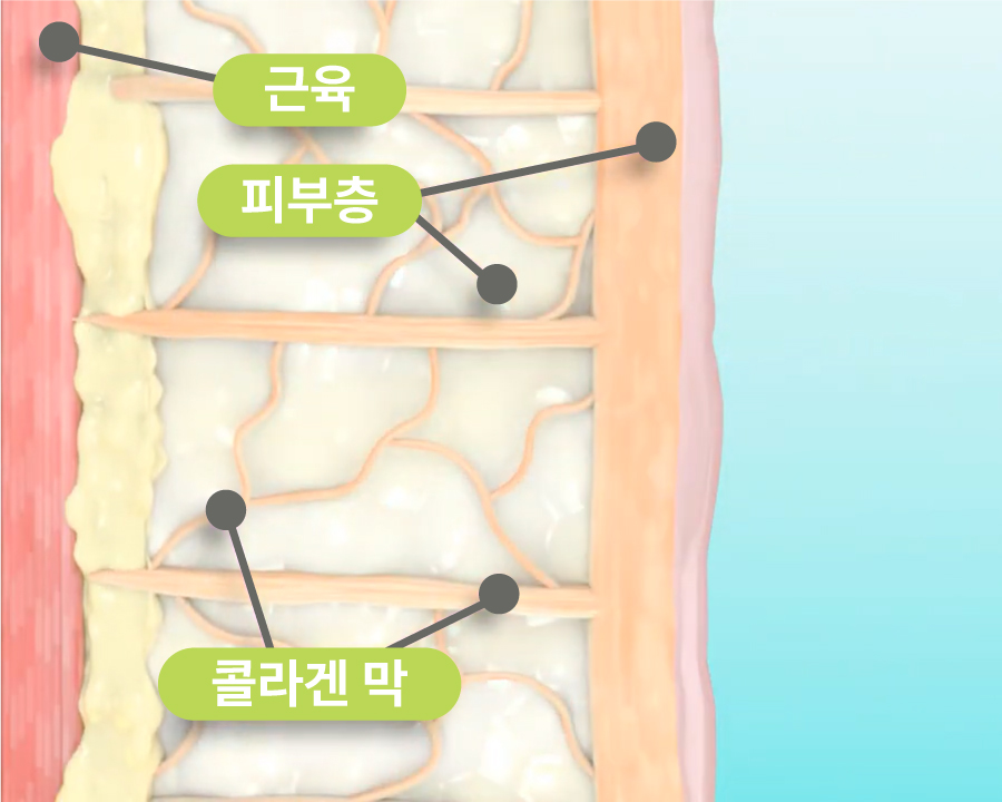 Thermage FLX